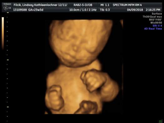 Ivy ultrasound 2