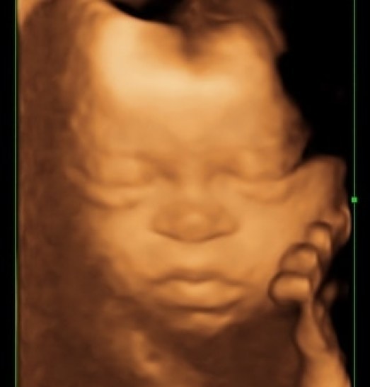 Ivy ultrasound 4