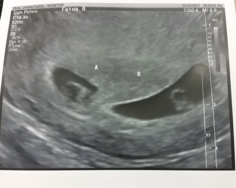 Twin ultrasound 2 (1) (1)
