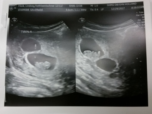 twin ultrasound 2